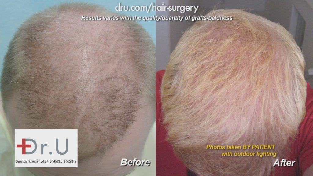 Before and after DrUGraft: fix asymmetric hairline Before and after DrUGraft: fix asymmetric hairline