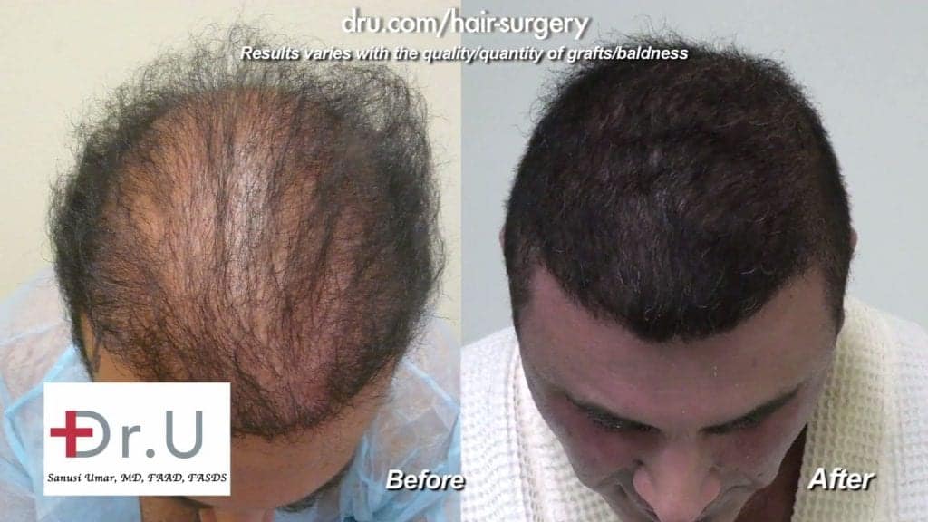 Does body hair transplant really work: The crown: much thicker coverage after Dr.UGraft Does body hair transplant really work: The crown: much thicker coverage after Dr.UGraft