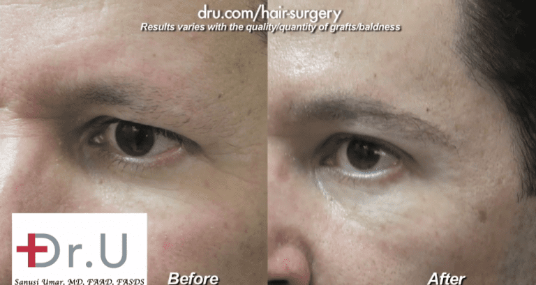 Side view of male eyebrow restoration using leg hair for donor grafts Side view of male eyebrow restoration using leg hair for donor grafts