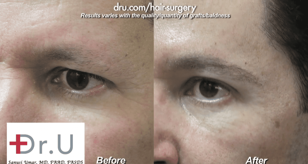 Dr.UGraft™’s ease of use when it comes to the utilization of body hair makes natural-looking eyebrow transplants a non-issue.* Dr.UGraft™’s ease of use when it comes to the utilization of body hair makes natural-looking eyebrow transplants a non-issue.*
