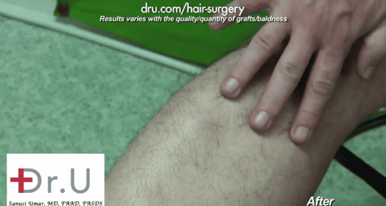 Leg donor area after surgical treatment for sparse brows shows excellent signs of healing Leg donor area after surgical treatment for sparse brows shows excellent signs of healing