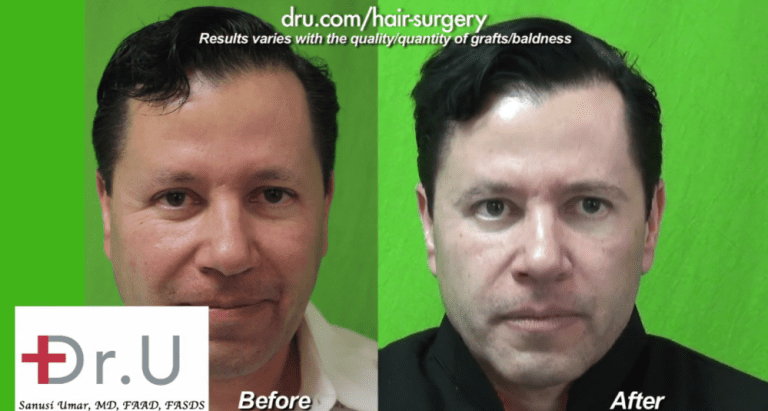 This patient's surgical treatment for sparse brows with leg hair made a significant difference in the overall appearance of his face. This patient's surgical treatment for sparse brows with leg hair made a significant difference in the overall appearance of his face.