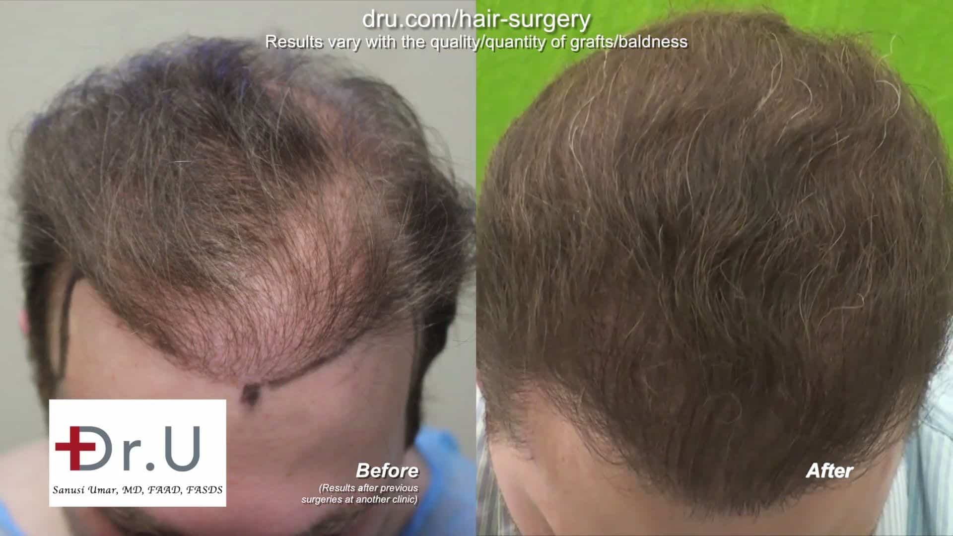 DrUGraft body hair FUE Restores donor depleted bald patient: Patient after treatment from Dr. Umar DrUGraft body hair FUE Restores donor depleted bald patient: Patient after treatment from Dr. Umar