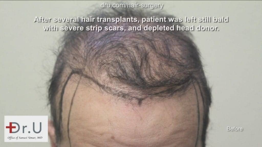 This patient asked himself, can a hair transplant really work for the hairline? Dr. Umar was able to come up with a realistic plan and graft count to create the changes that were desired. This patient asked himself, can a hair transplant really work for the hairline? Dr. Umar was able to come up with a realistic plan and graft count to create the changes that were desired.