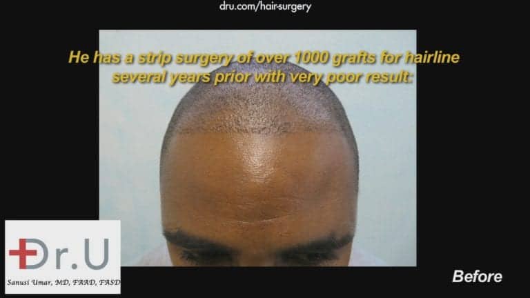 Receding hairlines in black men should be treated with specialized tools to help ensure the best yield possible. This African American patient did not experience the growth he wanted Receding hairlines in black men should be treated with specialized tools to help ensure the best yield possible. This African American patient did not experience the growth he wanted