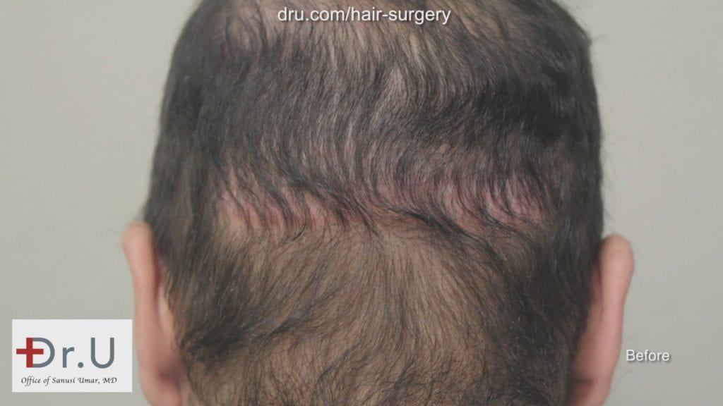 This patient had a linear scar from a hair transplant procedure at another clinic. Photo showing patient before his hair transplant reparative surgery with Dr. Umar showing the linear hair restoration scar left behind from a previous procedure.