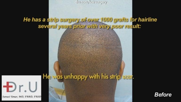 Strip hair transplantation for African Americans is often not compatible with the fact that many men of this demographic prefer very short hair styles. Therefore, linear scars are extremely visible Strip hair transplantation for African Americans is often not compatible with the fact that many men of this demographic prefer very short hair styles. Therefore, linear scars are extremely visible