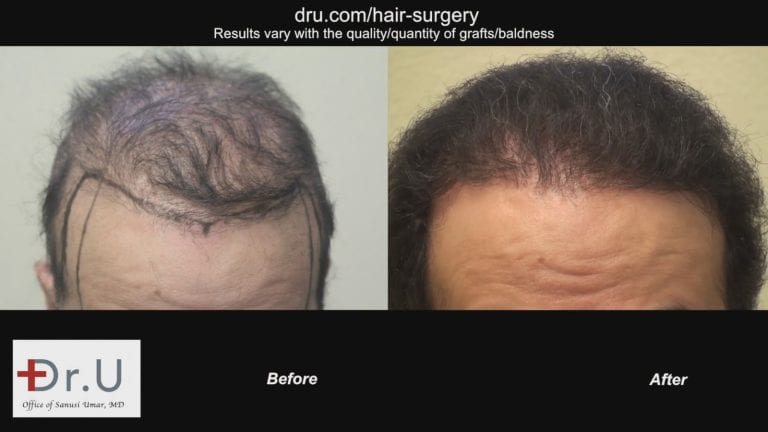 Dr.Umar restores entire head of hair using 1100 grafts taken from the scalp and the body. Dr.Umar restores entire head of hair using 1100 grafts taken from the scalp and the body.