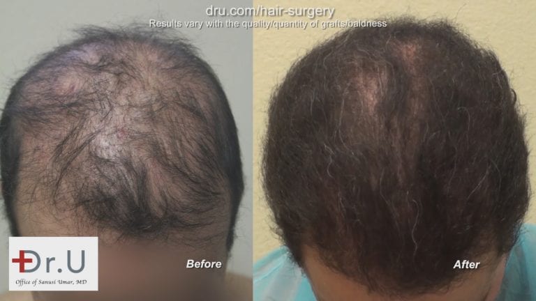 Before and after a Dr.UGraft hair transplant repair using 1100 donor grafts of body and head hair. Before and after a Dr.UGraft hair transplant repair using 1100 donor grafts of body and head hair.