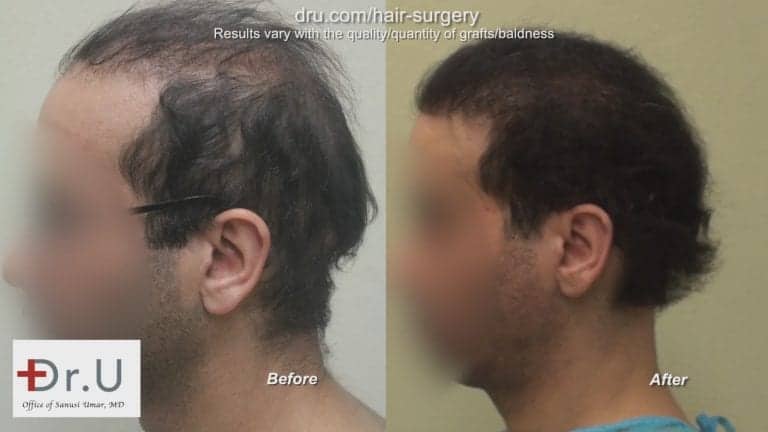 The Dr.UGraft can reverse the results of a poor hair transplant. This patient's case used body hair grafts for his bad hair transplant repair procedure The Dr.UGraft can reverse the results of a poor hair transplant. This patient's case used body hair grafts for his bad hair transplant repair procedure