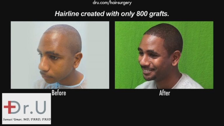 The results the Dr.UGrafti™ system is able to achieve speak for themselves.* The results the Dr.UGrafti™ system is able to achieve speak for themselves.*