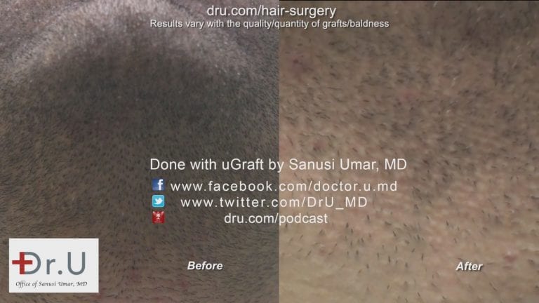 The Donor area: Before and After The Dr.UGraft™ left behind no visible hair restoration scar remains at the beard donor area