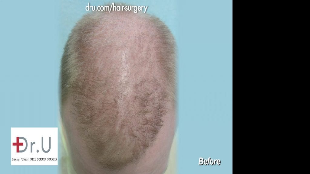 After an FUE hair transplant form a clinic in India, the patient was left with an asymmetric looking hairline After an FUE hair transplant form a clinic in India, the patient was left with an asymmetric looking hairline