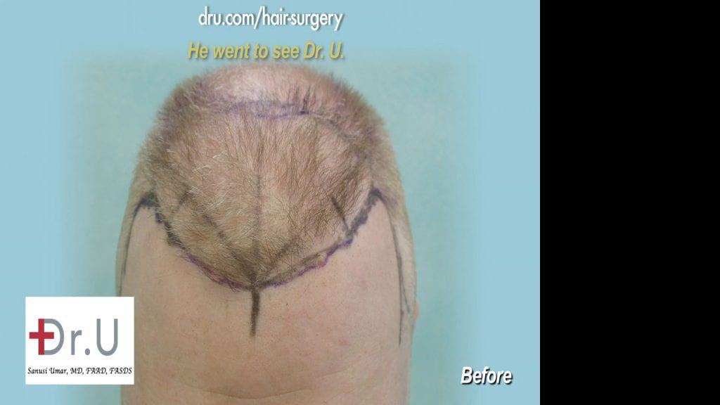 Dr U Uses the patients facial anatomic landmarks to construct hairline and temples in a manner that fixes the uneven hairline Dr U Uses the patients facial anatomic landmarks to construct hairline and temples in a manner that fixes the uneven hairline