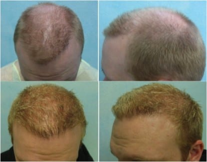 How to fix uneven hairline with the DrUGraft How to fix uneven hairline with the DrUGraft