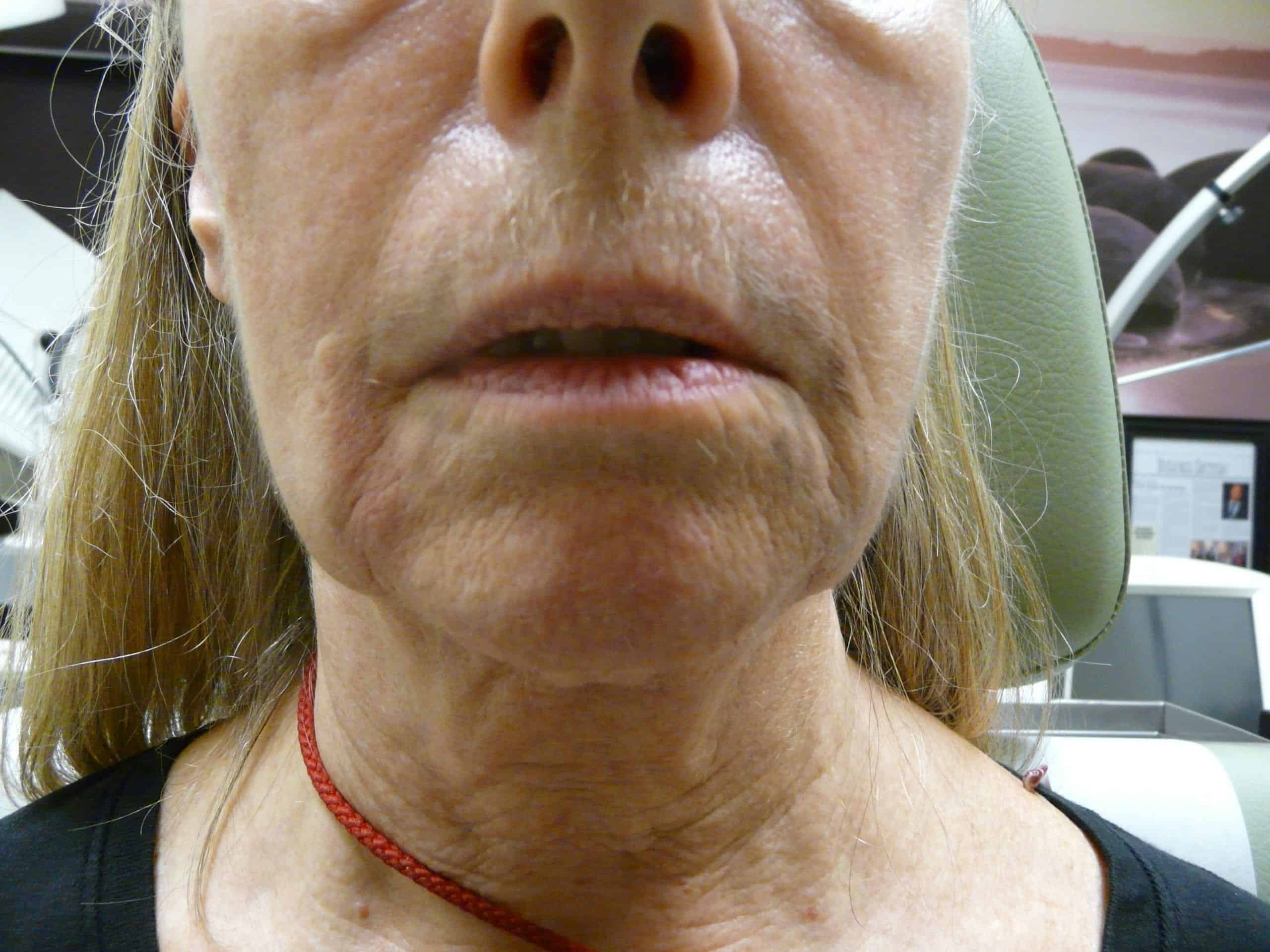 Before non surgical jowllift in beverly hills patient using dermal fillers. Before non surgical jowllift in beverly hills patient using dermal fillers.