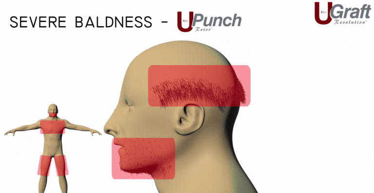 Dr.UGraft ™ technology is able to pull hair from the beard, head and body to create fuller coverage on the top the head. Dr.UGraft ™ technology is able to pull hair from the beard, head and body to create fuller coverage on the top the head.