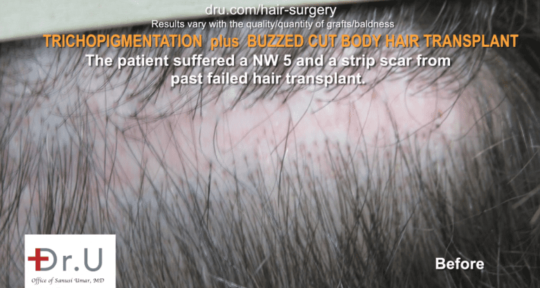 The patient before Dr.UGraft FUE Plus SMP. The patient before Dr.UGraft FUE Plus SMP.