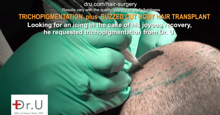 The patient undergoes body hair transplant and SMP combo. The patient undergoes body hair transplant and SMP combo.