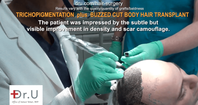 SMP affect hair transplant success in LA patient. SMP affect hair transplant success in LA patient.