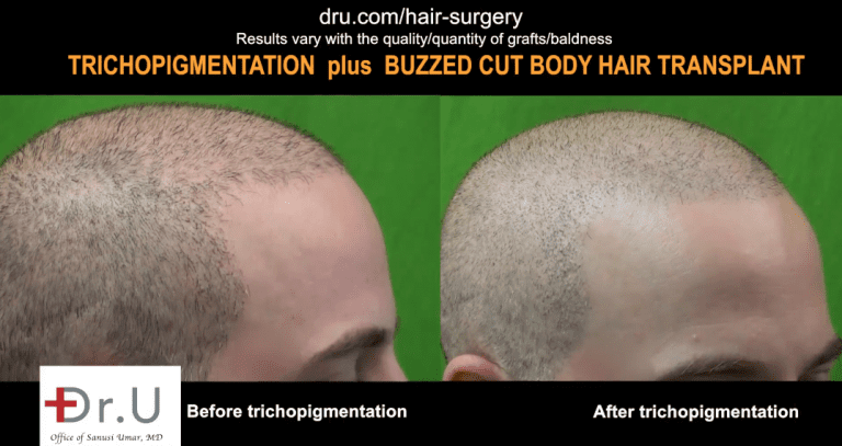 Incredible results of SMP after FUE hair transplant. Incredible results of SMP after FUE hair transplant.