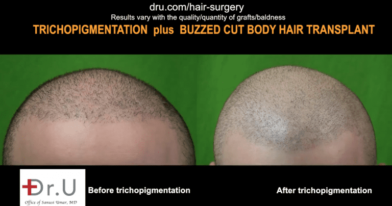 Dr.UGraft FUE Plus SMP Before and After SMP affect hair transplant success