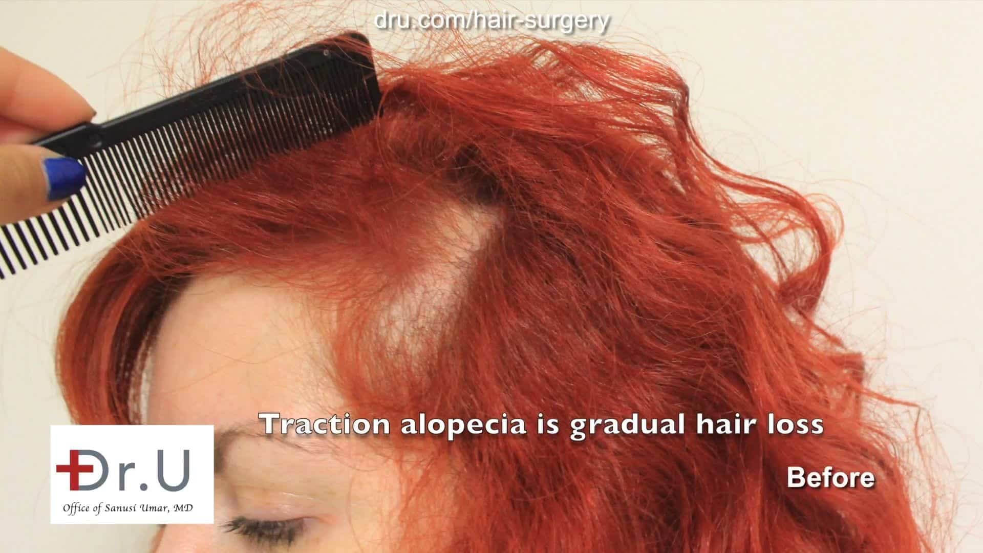 Before hair transplant for female traction alopecia using Dr UGraft Before hair transplant for female traction alopecia using Dr UGraft