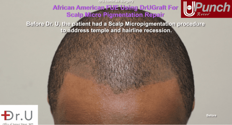 An example of bad African american scalp tattoos, before Dr.UPunch. An example of bad African american scalp tattoos, before Dr.UPunch.