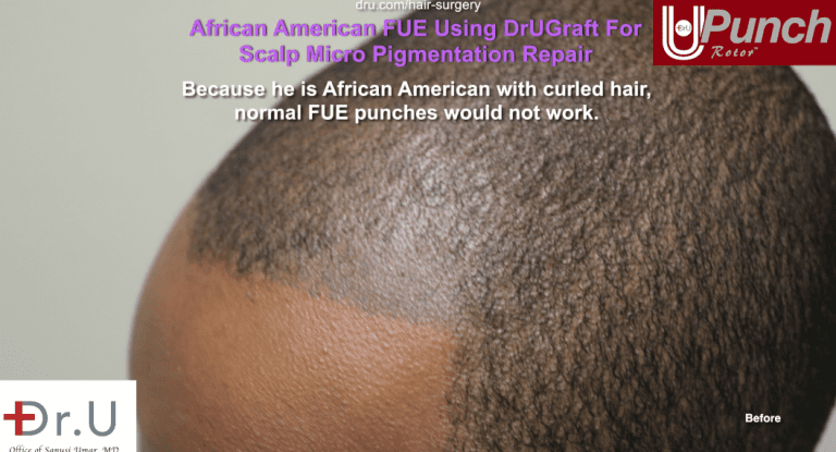 A botched tattooed hairline before Dr.UPunch. A botched tattooed hairline before Dr.UPunch.