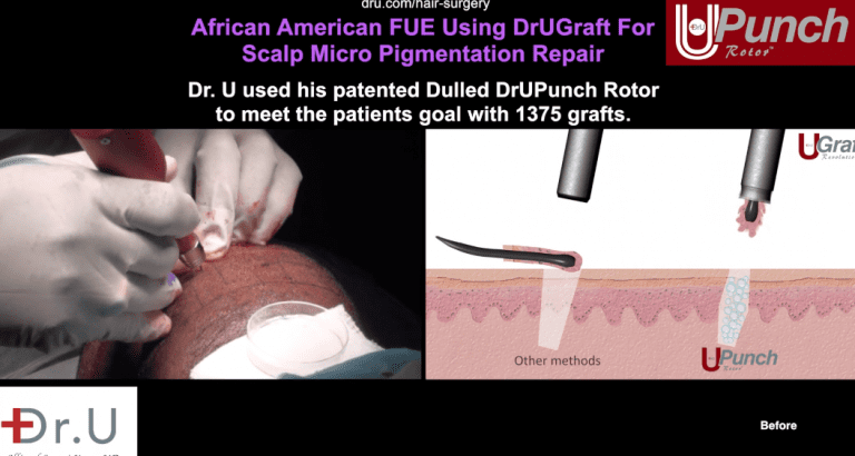 Dr U used his patented, dulled Dr.UPunch Rotor for SMP repair. Dr U used his patented, dulled Dr.UPunch Rotor for SMP repair.