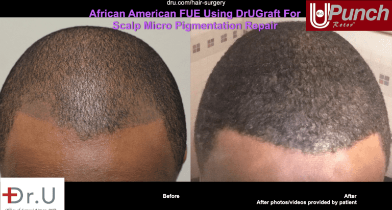 The patient's bad hair tattoo before and after repair. The patient's bad hair tattoo before and after repair.