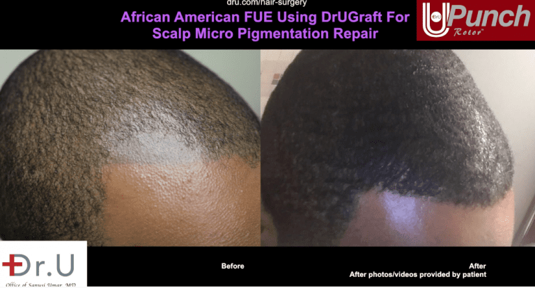 The results of bad hair tattoo repair by Dr.UPunch. The results of bad hair tattoo repair by Dr.UPunch.