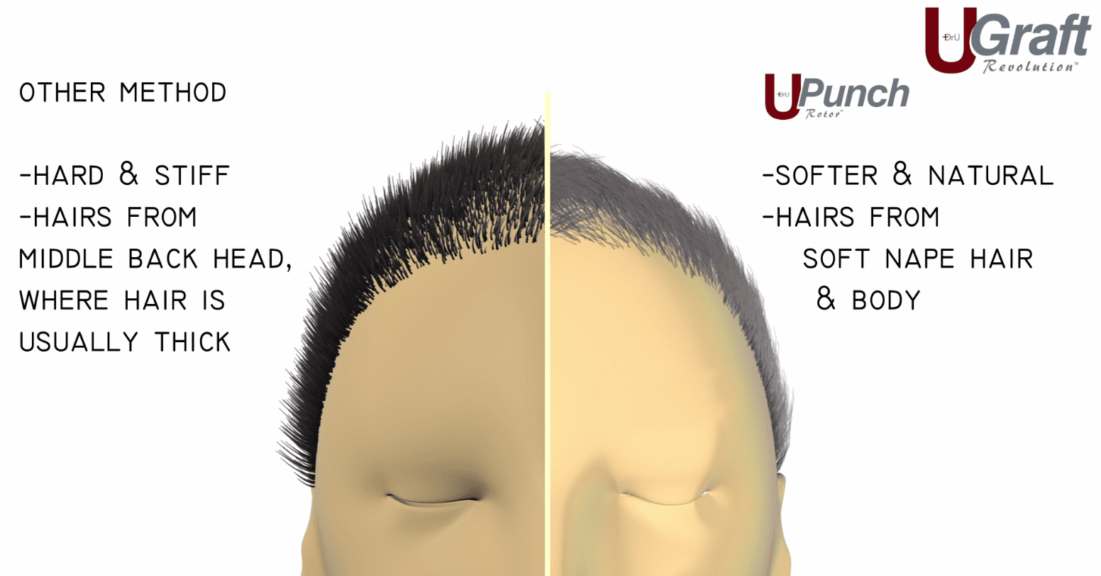 Dr.UGraft FUE Repair Procedure Dr.UGraft FUE Repair Procedure