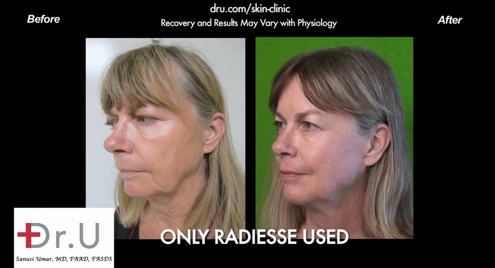 This patient used radiesse for a jowl reduction without surgery* This patient used radiesse for a jowl reduction without surgery*