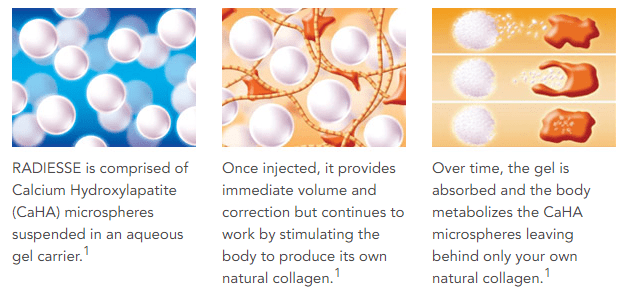 Radiesse works quickly to provide nearly instant results continues to work by encouraging the body's natural production of collagen. (Image source: http://www.radiesse.com/ )