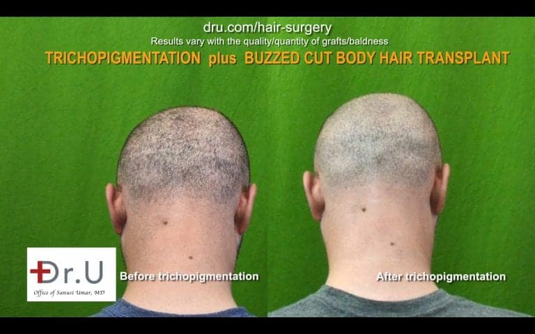 Shaved head after FUE by Dr.UGraft and Scalp Micropigmentation SMP achieved look of density in Santa Monica Los Angeles Patient. Shaved head after FUE by Dr.UGraft and Scalp Micropigmentation SMP achieved look of density in Santa Monica Los Angeles Patient.