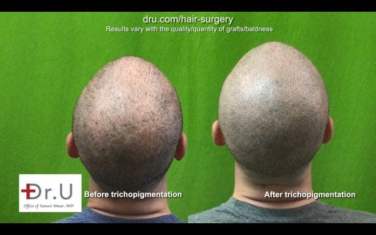 Get rid of hair transplant scar with Dr.UGraft FUE and SMP combination. Get rid of hair transplant scar with Dr.UGraft FUE and SMP combination.