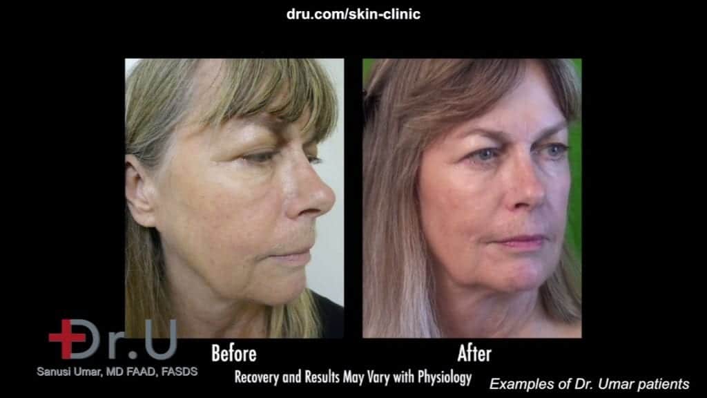 Non surgical liquid facelift using Radiesse by Dr. U prevents the need for a lower facelift.* non surgical jowl lift In beverly hills patient