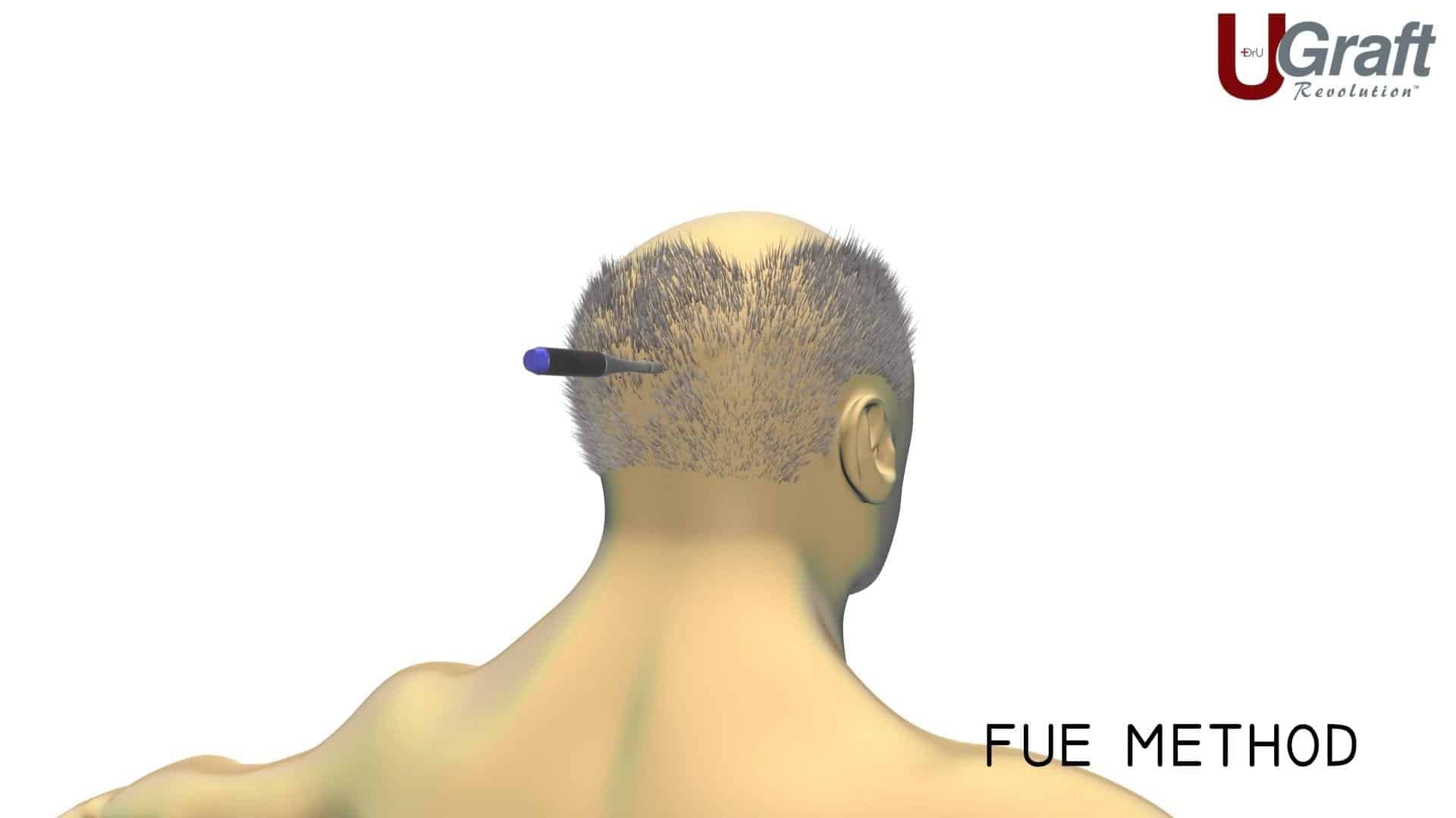 Dr. Umar deployed his advanced FUE method to extract 200 grafts from this patients head in order to fill in her temples. This photo shows how the FUE tool works to extract individual hair follicles to avoid any significant scarring. Dr. Umar deployed his advanced FUE method to extract 200 grafts from this patients head in order to fill in her temples. This photo shows how the FUE tool works to extract individual hair follicles to avoid any significant scarring.