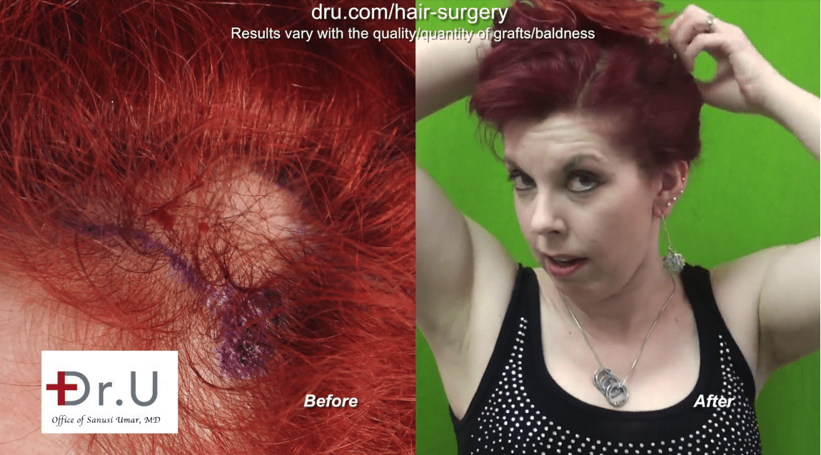 Patient is happy with her traction alopecia treatment results at the Dr. U Hair and Skin Clinic.* Patient is happy with her traction alopecia treatment results at the Dr. U Hair and Skin Clinic.*