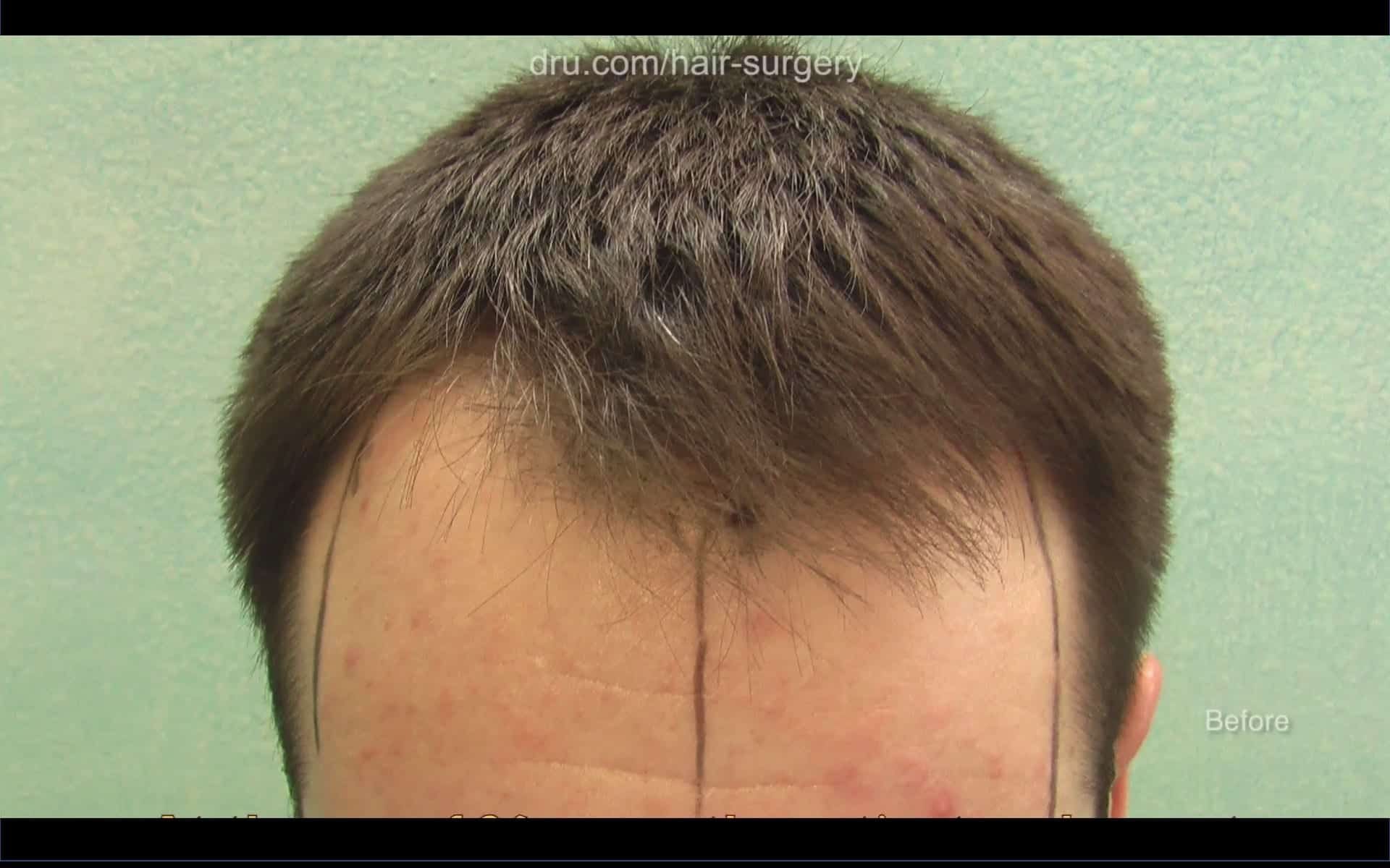 If done at too young an age, a patient can still experience hair loss after hair transplant: Patient's hair loss before treatment If done at too young an age, a patient can still experience hair loss after hair transplant: Patient's hair loss before treatment