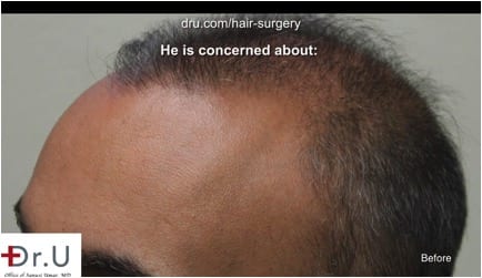 Weak and thinning temple points prior to hair transplant correction using DrUGraft Weak and thinning temple points prior to hair transplant correction using DrUGraft