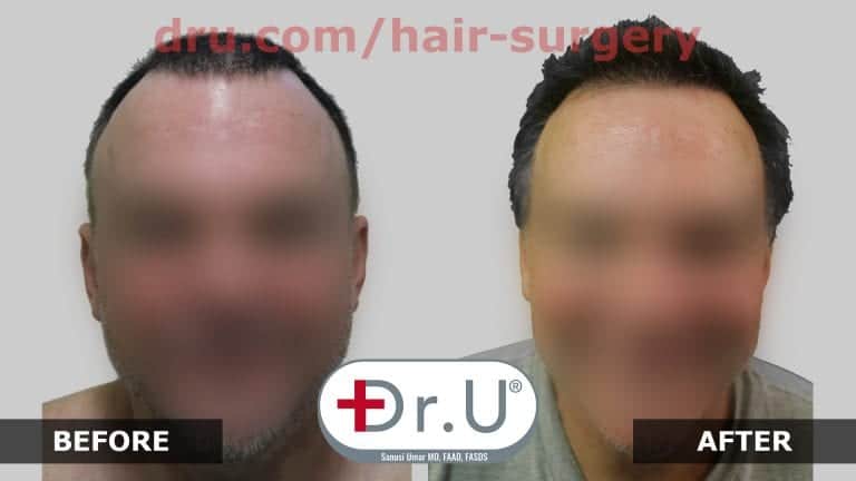 Dr.UGraft FUE Restoration: Before and After Photos Dr.UGraft FUE Restoration: Before and After Photos