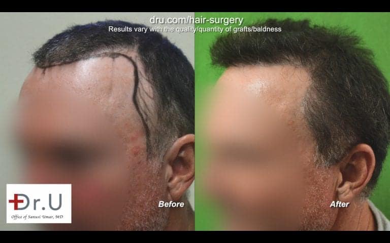 Dr.UGraft FUE Restoration: Before and After Photos Dr.UGraft FUE Restoration: Before and After Photos