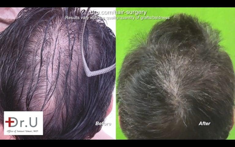 Dr.UGraft FUE Restoration: Before and After Photos Dr.UGraft FUE Restoration: Before and After Photos