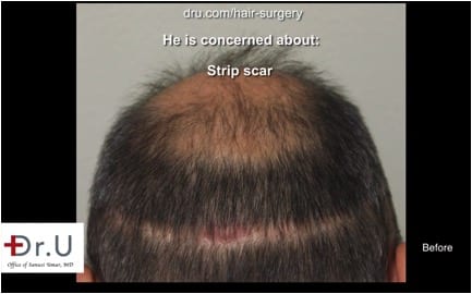 Beverly Hill's patient with visible scarring caused by surgery performed by another clinic . Beverly Hill's patient with visible scarring caused by surgery performed by another clinic .