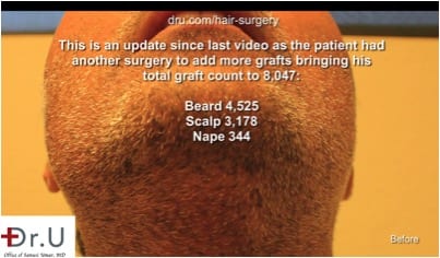Primary donor area for the Dr.UGraft corrective hair surgery. Primary donor area for the Dr.UGraft corrective hair surgery