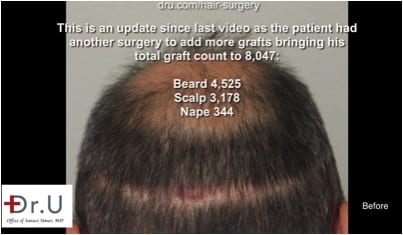 Highly visible linear wound required a repair surgery to cover this strip scar Highly visible linear wound required a repair surgery to cover this strip scar