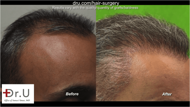 Stronger and fuller temple points after the Dr.UGraft repair to fix unsuccessful hair transplant from strip surgery Stronger and fuller temple points after the Dr.UGraft repair to fix unsuccessful hair transplant from strip surgery