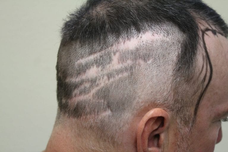 Previous bad hair surgery outcome